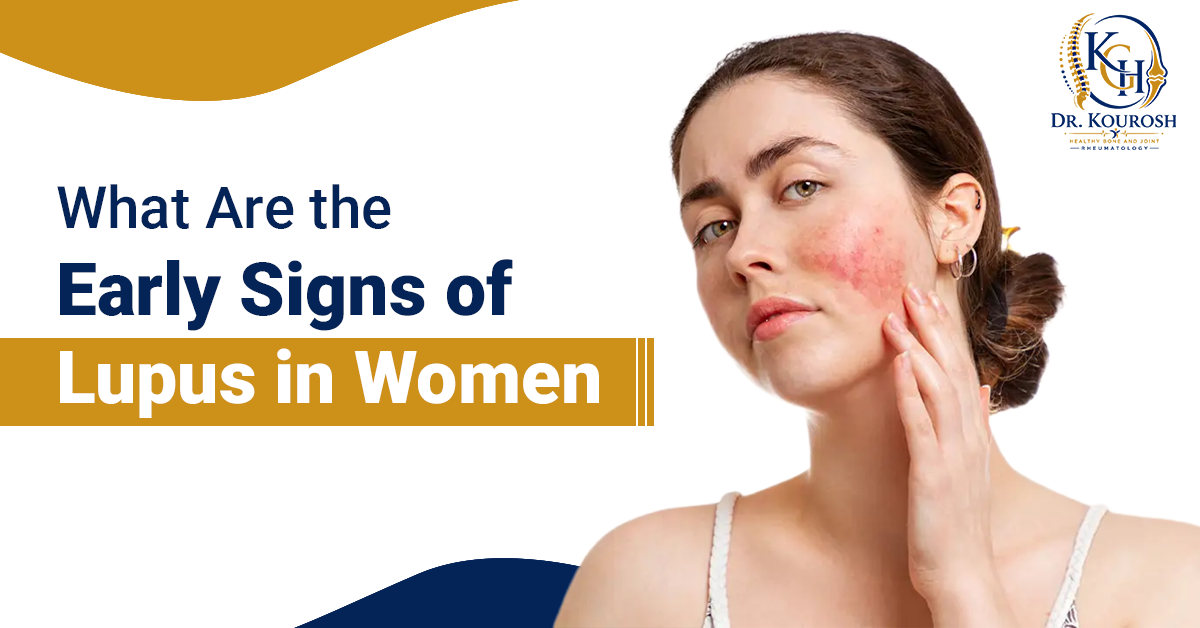 Signs of Lupus in Women
